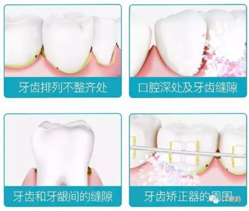 牙齿嵌体修复价格（一般牙齿嵌体的价格）(图1)